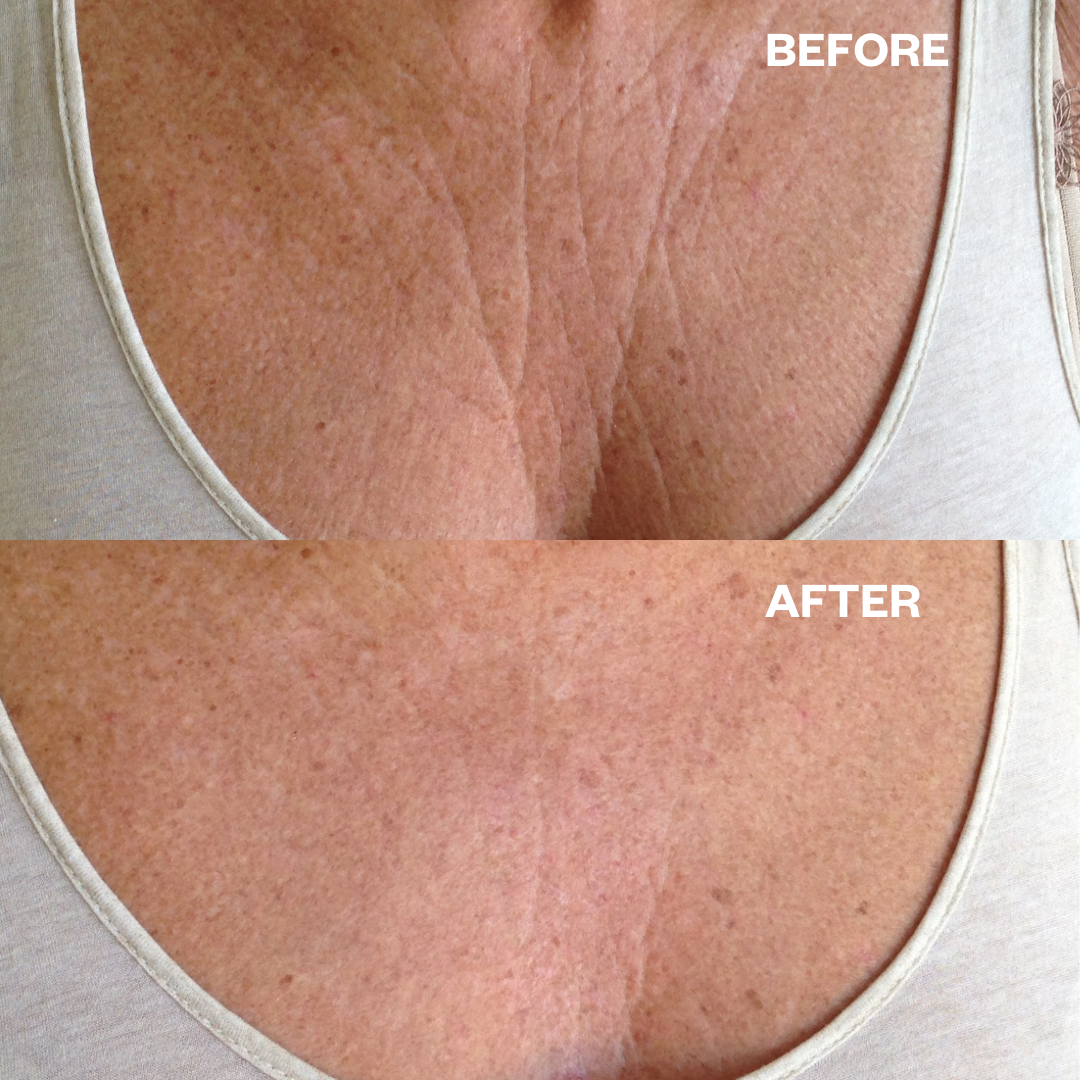 Smooth Out Chest and Cleavage Wrinkles with These 3 Treatments