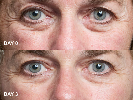 Wrinkles Schminkles blog banner for eye wrinkle patches, a non-invasive alternative to aesthetic treatments for crow's feet and dark circles
