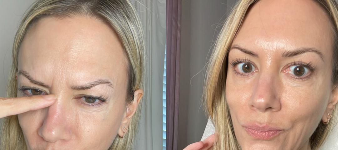 Face Taping with 100% Medical Grade Silicone Patches <p> Heather Ertel’s Overnight Results