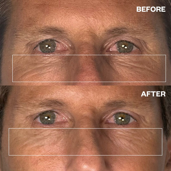 Before and after results using Men's Pro Eye Wrinkle Patches for under-eye wrinkles
