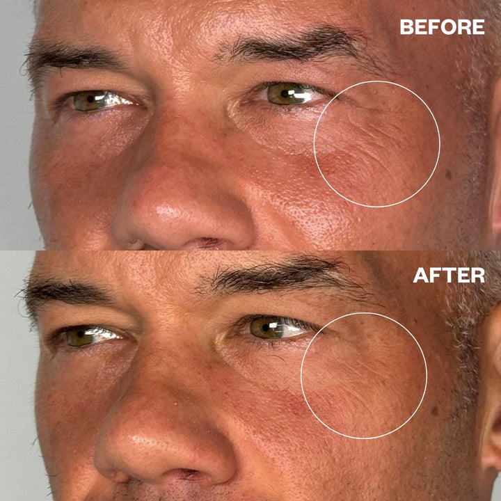 Before and after results using Men's Pro Eye Wrinkle Patches for crow's feet and fine lines