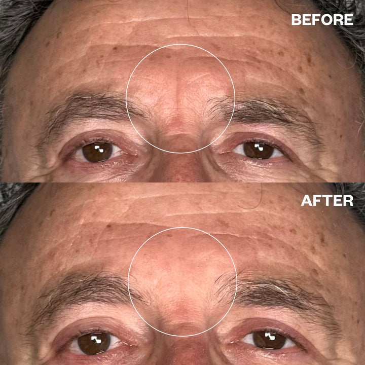 Before and after results using Men's Pro Forehead Wrinkle Patches for forehead lines