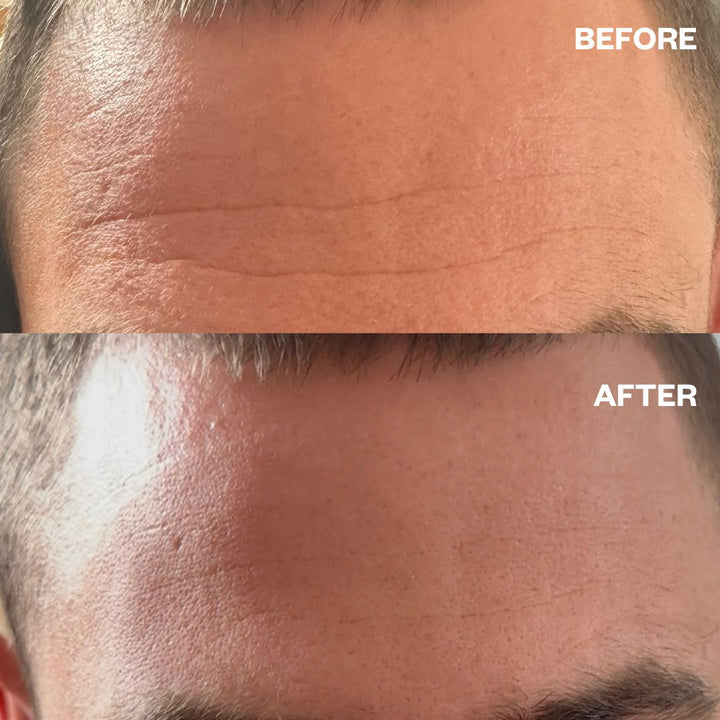 Before and after results using Men's Pro Forehead Wrinkle Patches