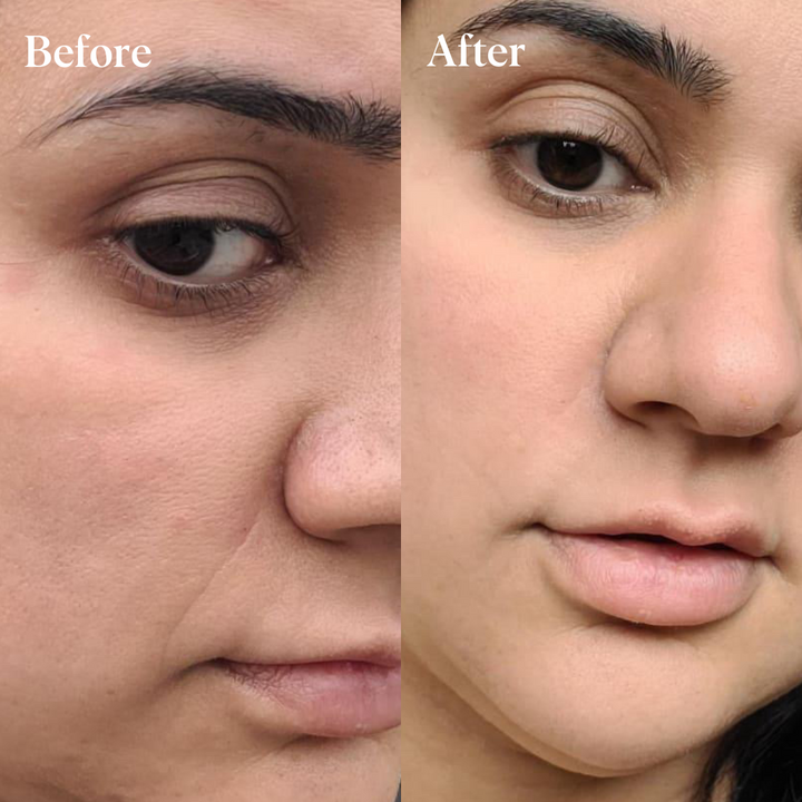 Under-Eye Lift Bundle