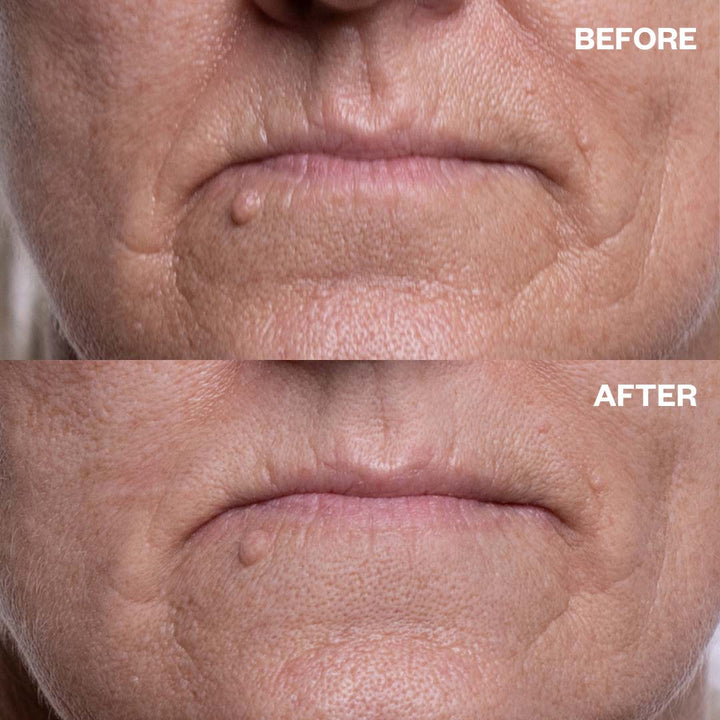 Mouth & Lip Wrinkle Patches