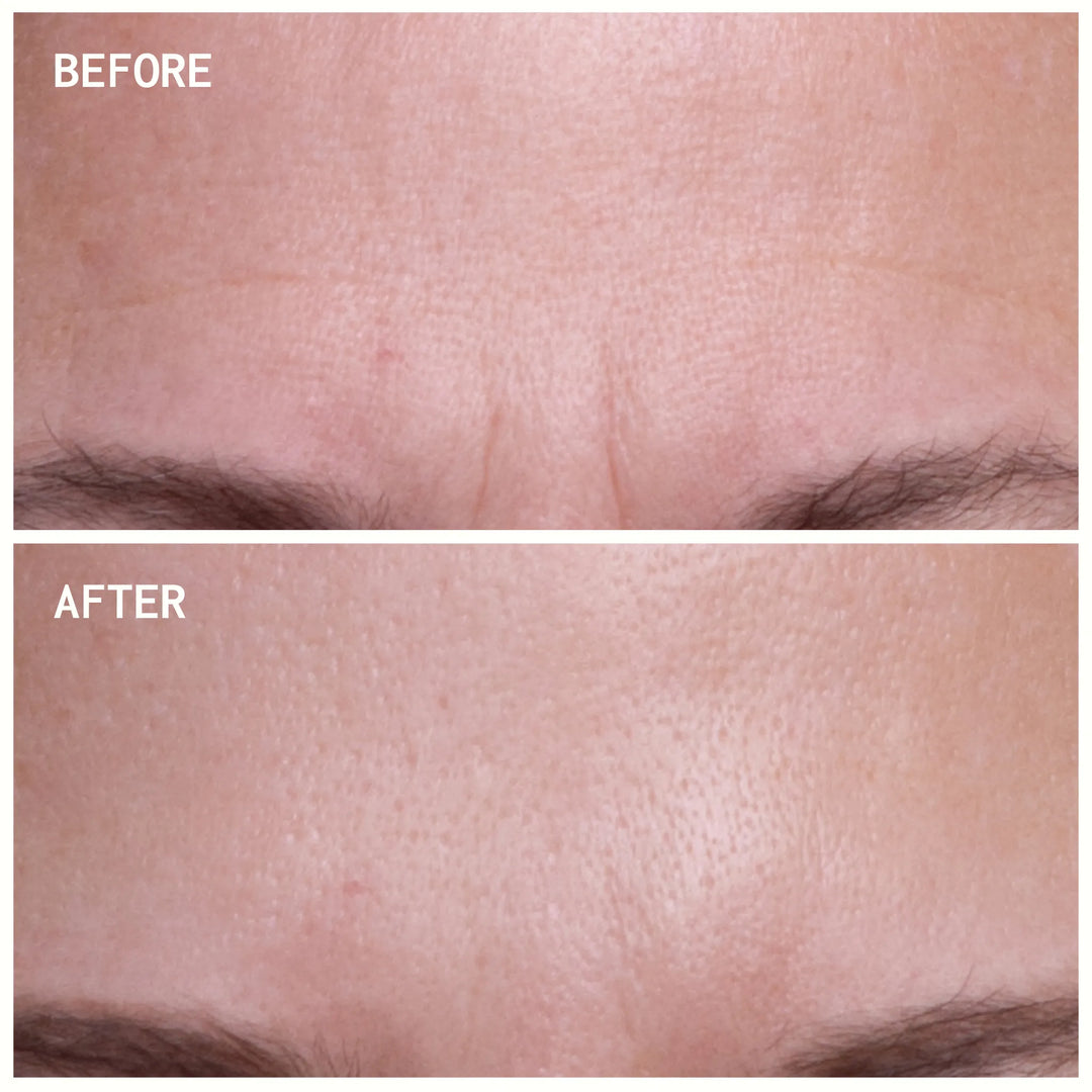 Forehead Wrinkle Patches