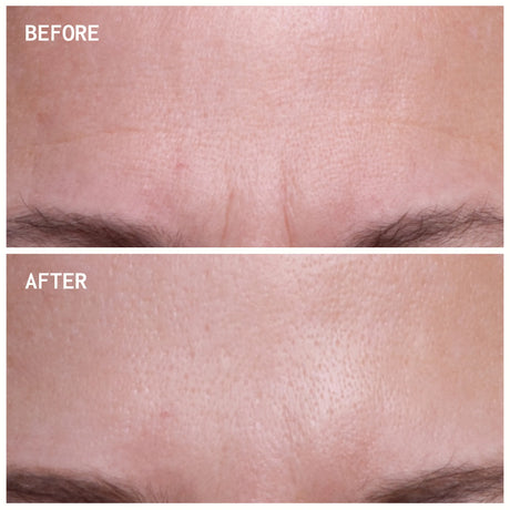 Wrinkles Schminkles Forehead Wrinkles | Trial Patch packaging