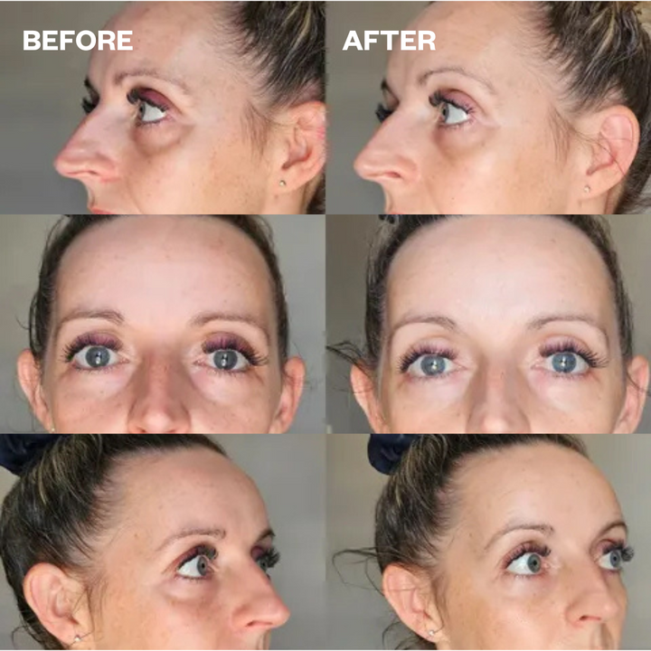 Under-Eye Lift Bundle