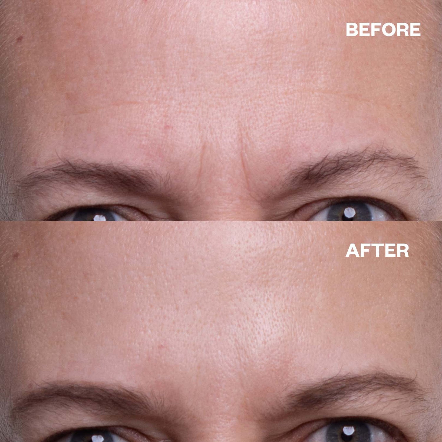 Before and after results using Forehead Wrinkle Patch (TT) for forehead lines
