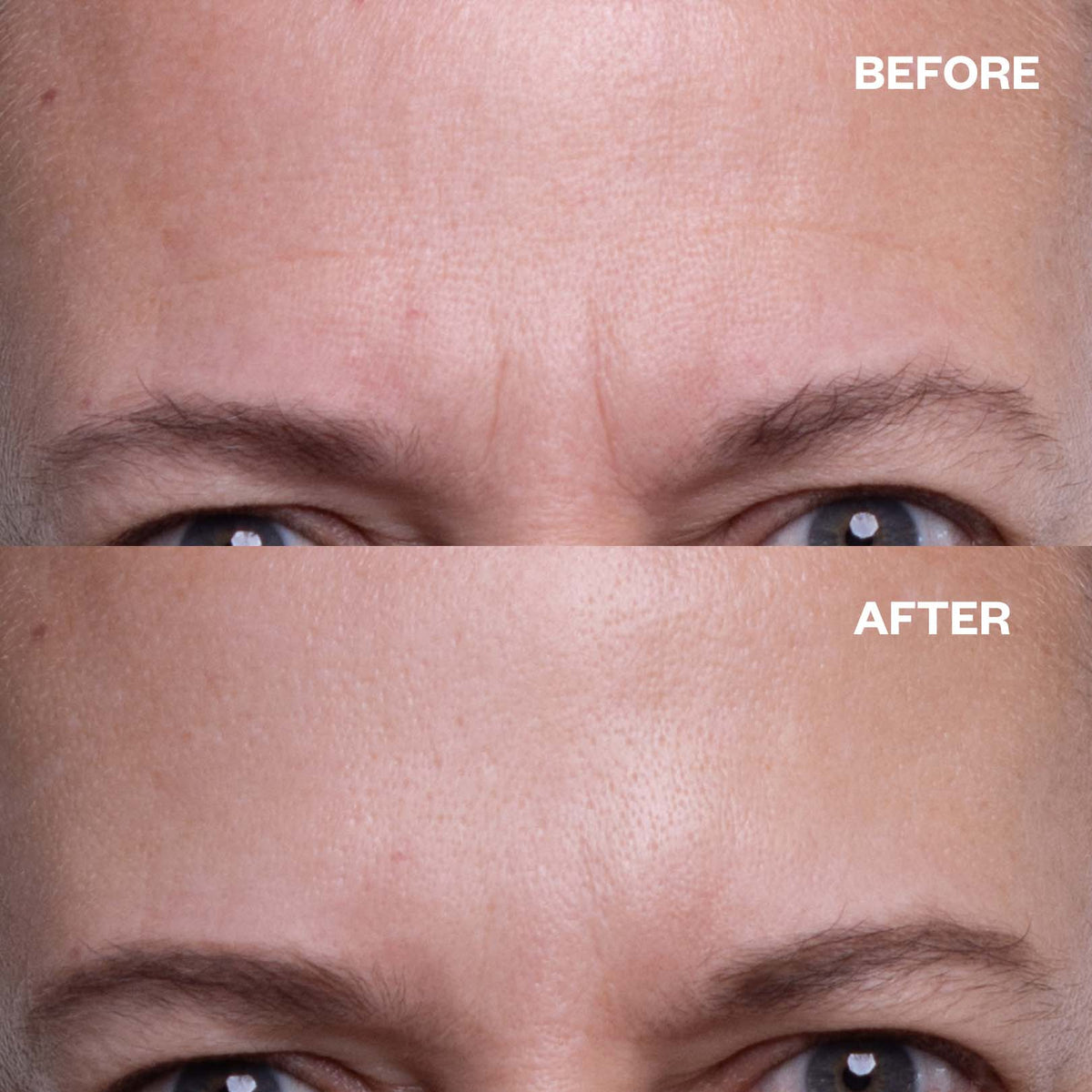 Before and after results using Forehead Wrinkle Patch (TT) for forehead lines