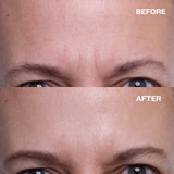 Before and after results using Forehead Wrinkle Patch (TT) for forehead lines