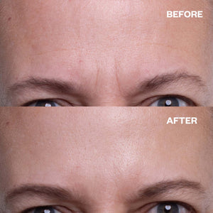 Before and after results using Forehead Wrinkle Patch (TT) for forehead lines