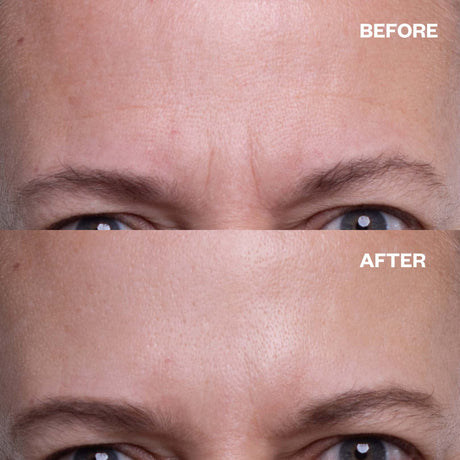 Before and after results using Forehead Wrinkle Patch (TT) for forehead lines