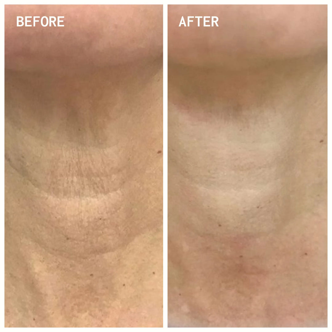 Neck Wrinkle Patches