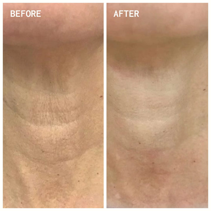 Neck Wrinkle Patches