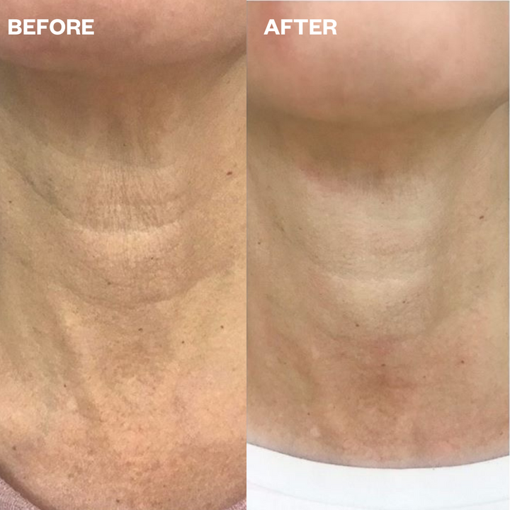 ws_neck_beforeafter